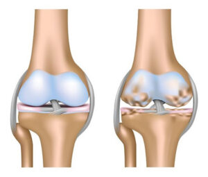 Thoái hóa khớp gối