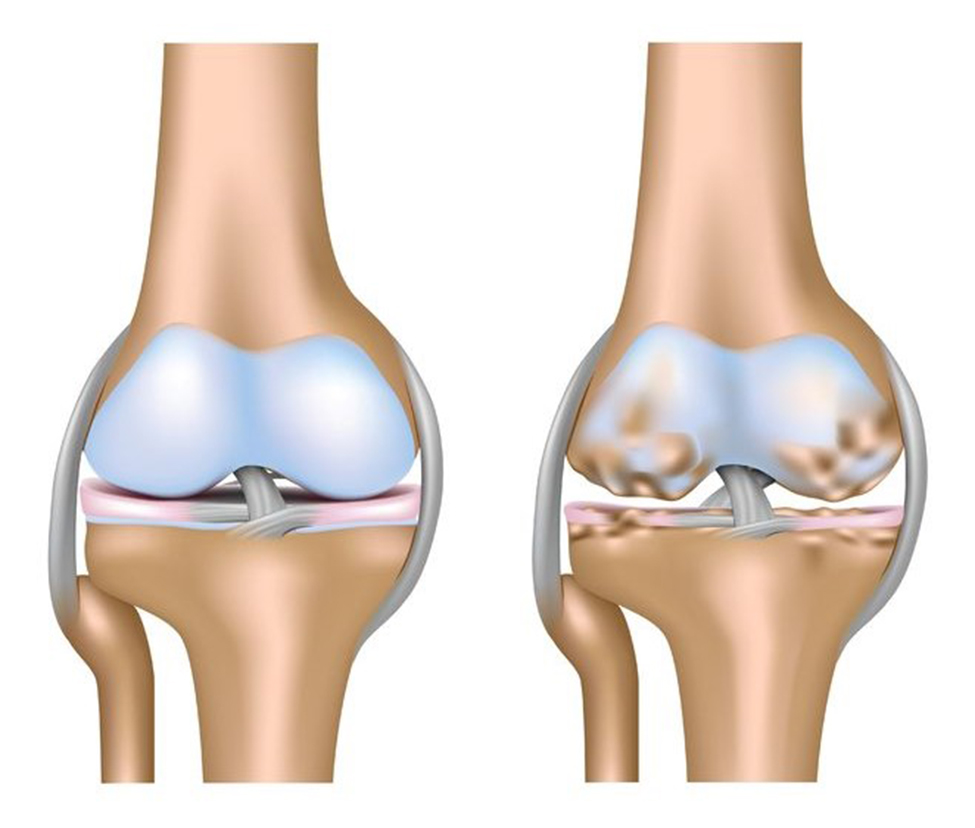 Thoái hóa khớp gối