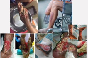 Biến chứng bàn chân tiểu đường